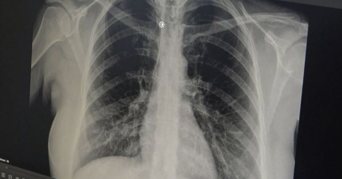 Prof. Dr. Özlü’den ‘akut bronşit’ uyarısı!